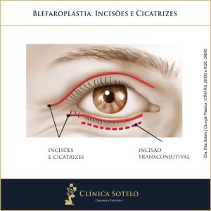 blefaroplastia incisões e cicatrizes