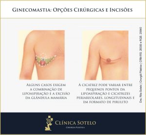 ginecomastia retirada da glândula mamária