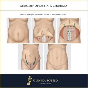 abdominoplastia a cirurgia
