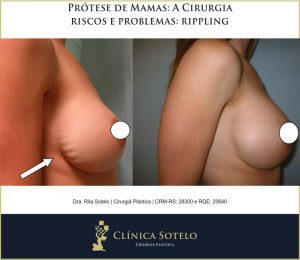 protese mamaria rippling