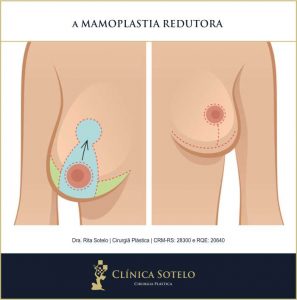 mamoplastia redutora antes e depois