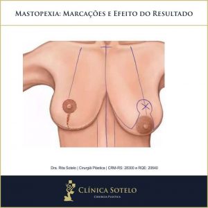 cirurgia de mastopexia com prótese